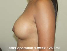 plastic-surgery-breast-augmentation 